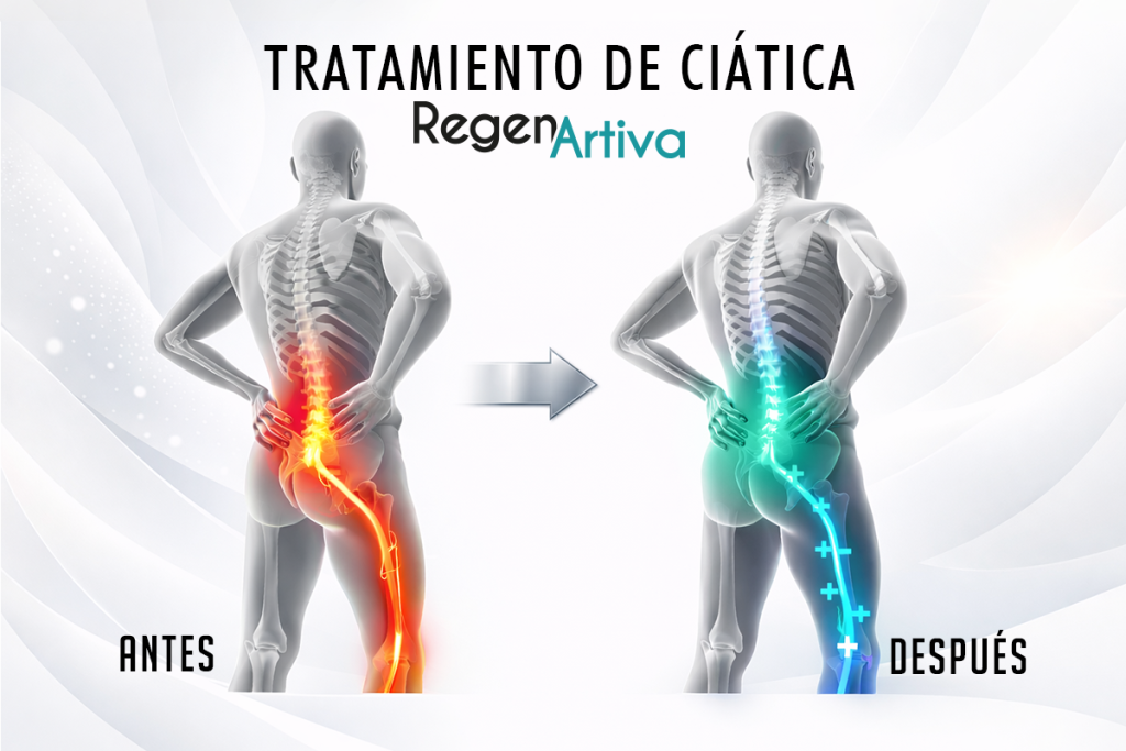 CIATICA REGENARTIVA2
